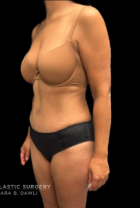 Abdominoplasty (Tummy Tuck) Before and After Pictures in Buffalo, NY