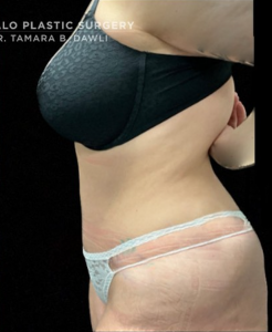 Abdominoplasty (Tummy Tuck) Before and After Pictures in Buffalo, NY