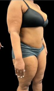 Abdominoplasty (Tummy Tuck) Before and After Pictures in Buffalo, NY