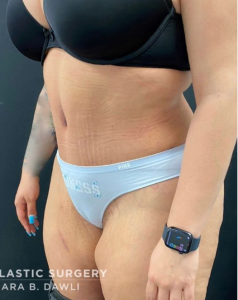 Abdominoplasty (Tummy Tuck) Before and After Pictures in Buffalo, NY