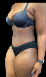 Abdominoplasty (Tummy Tuck) Before and After Pictures in Buffalo, NY