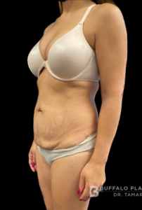 Abdominoplasty (Tummy Tuck) Before and After Pictures in Buffalo, NY