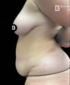 Abdominoplasty (Tummy Tuck) Before and After Pictures in Buffalo, NY