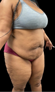 Abdominoplasty (Tummy Tuck) Before and After Pictures in Buffalo, NY