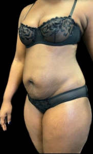 Abdominoplasty (Tummy Tuck) Before and After Pictures in Buffalo, NY