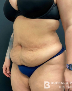 Abdominoplasty (Tummy Tuck) Before and After Pictures in Buffalo, NY