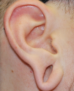 Earlobe Reconstruction Before and After Pictures Buffalo, NY