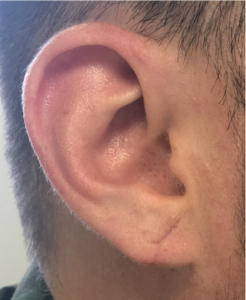 Earlobe Reconstruction Before and After Pictures Buffalo, NY
