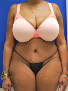 Abdominoplasty (Tummy Tuck) Before and After Pictures Buffalo, NY