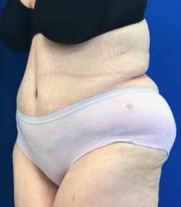 Abdominoplasty (Tummy Tuck) Before and After Pictures Buffalo, NY