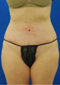 Abdominoplasty (Tummy Tuck) Before and After Pictures Buffalo, NY