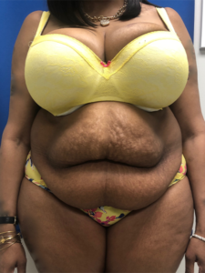 Abdominoplasty (Tummy Tuck) Before and After Pictures Buffalo, NY