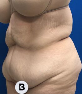 Abdominoplasty (Tummy Tuck) Before and After Pictures Buffalo, NY
