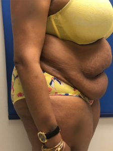 Abdominoplasty (Tummy Tuck) Before and After Pictures Buffalo, NY