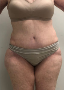 Abdominoplasty (Tummy Tuck) Before and After Pictures Buffalo, NY