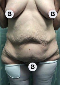 Abdominoplasty (Tummy Tuck) Before and After Pictures Buffalo, NY