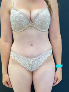 Abdominoplasty (Tummy Tuck) Before and After Pictures in Buffalo, NY