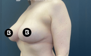 Breast Reduction Before and After Pictures in Buffalo, NY