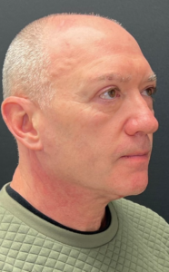 Necklift Before and After Pictures in Buffalo, NY