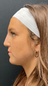 Liquid Rhinoplasty Before and After Pictures in Buffalo, NY