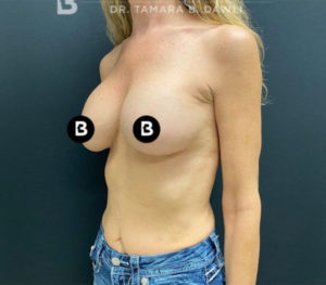 Breast Augmentation Before and After Pictures in Buffalo, NY