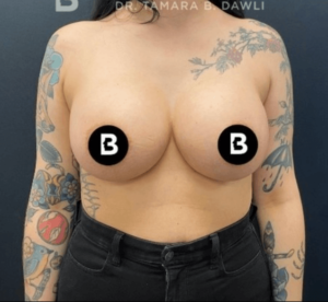 Abdominoplasty (Tummy Tuck) Before and After Pictures in Buffalo, NY