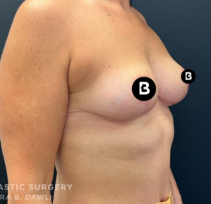 Mastopexy (Breast Lift) Before and After Pictures in Buffalo, NY