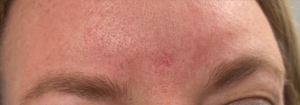 Mole Removal Before and After Pictures Buffalo, NY