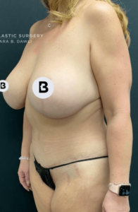 Mommy Makeover Before and After Pictures in Buffalo, NY
