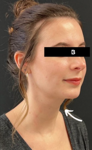 Facial Fat transfer Before and After Pictures in Buffalo, NY