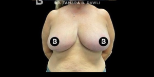Breast Reduction Before and After Pictures in Buffalo, NY