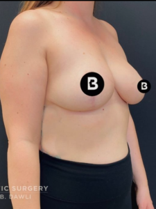 Breast Reduction Before and After Pictures in Buffalo, NY