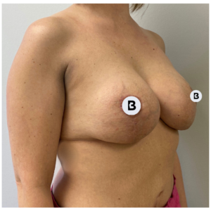 Breast Augmentation Before and After Pictures Buffalo, NY