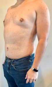 Liposuction Before and After Pictures in Buffalo, NY