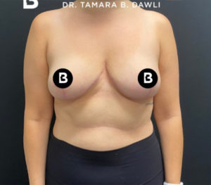 Breast Reduction Before and After Pictures in Buffalo, NY