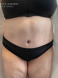 Abdominoplasty (Tummy Tuck) Before and After Pictures in Buffalo, NY