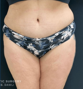 Abdominoplasty (Tummy Tuck) Before and After Pictures in Buffalo, NY