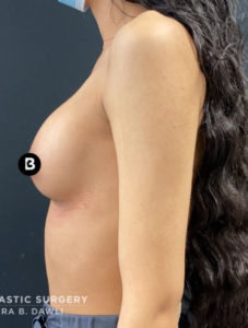 Abdominoplasty (Tummy Tuck) Before and After Pictures in Buffalo, NY