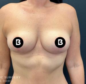 Mastopexy (Breast Lift) Before and After Pictures in Buffalo, NY