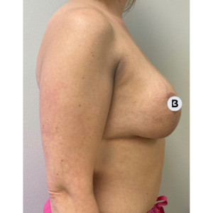 Breast Augmentation Before and After Pictures Buffalo, NY