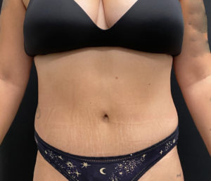 Abdominoplasty (Tummy Tuck) Before and After Pictures Buffalo, NY