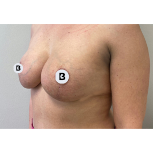 Breast Augmentation Before and After Pictures Buffalo, NY