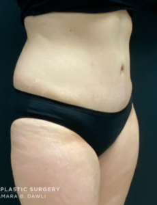 Abdominoplasty (Tummy Tuck) Before and After Pictures in Buffalo, NY