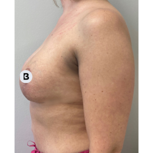 Breast Augmentation Before and After Pictures Buffalo, NY