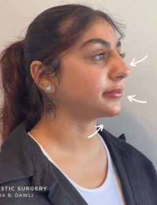 Facial Fillers Before and After Pictures in Buffalo, NY