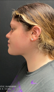Chin Liposuction Before and After Pictures Buffalo, NY