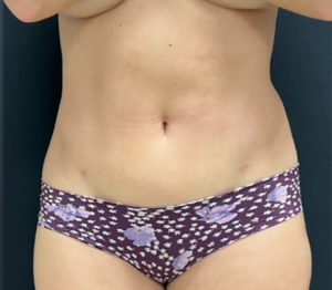 Liposuction Before and After Pictures in Buffalo, NY