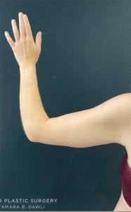 Brachioplasty (Arm Lift) Before and After Pictures Buffalo, NY