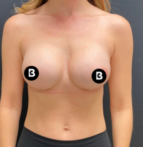 Breast Augmentation Before and After Pictures in Buffalo, NY