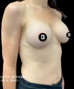 Breast Augmentation Before and After Pictures in Buffalo, NY